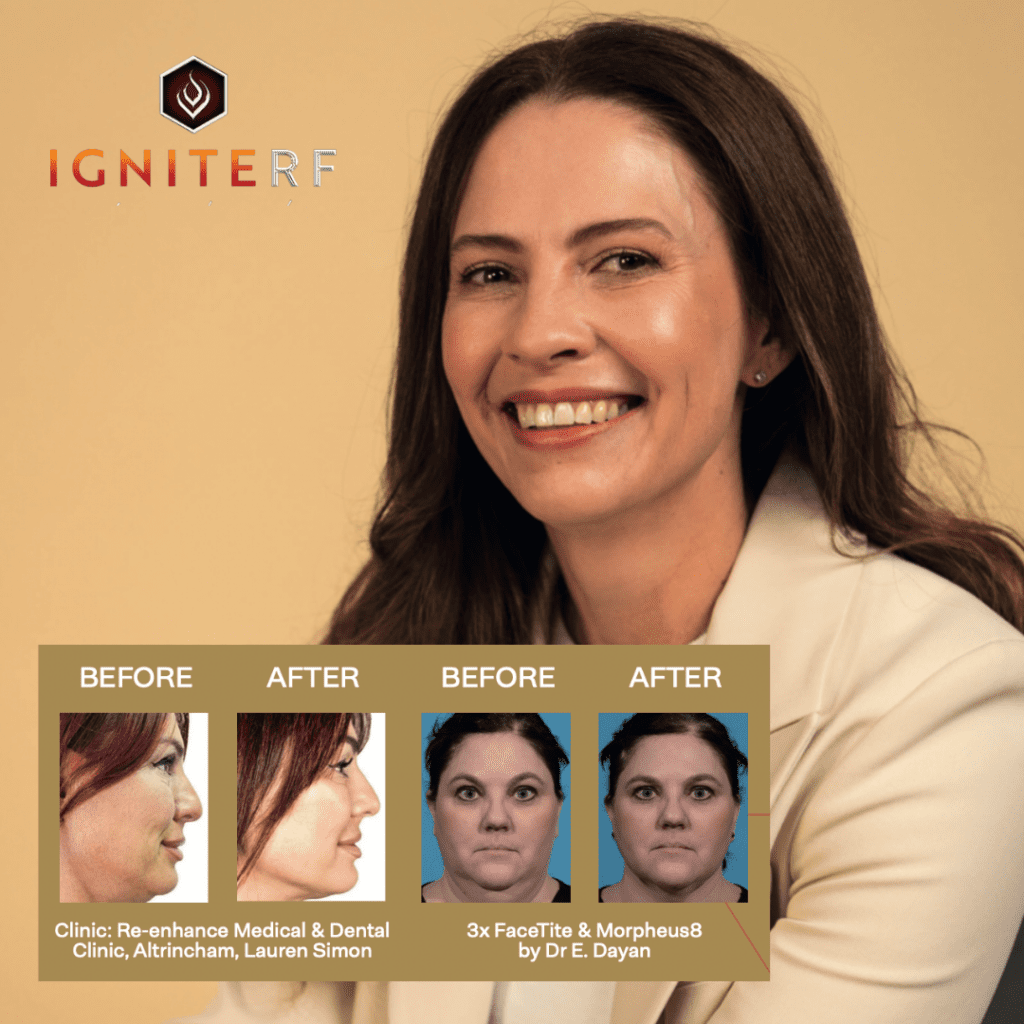 Ignite RF arrives at Amanda Azzopardi Aesthetics Liverpool